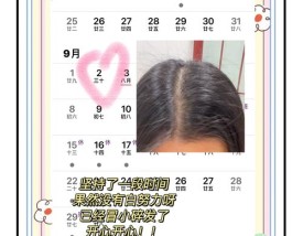 脱发严重是什么原因引起的／20多岁脱发严重是什么原因引起的